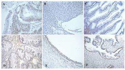 Role of Retinoblastoma Protein Family (Rb/p105 and Rb2/p130) Expression in the Histopathological Classification of Borderline Ovarian Tumors